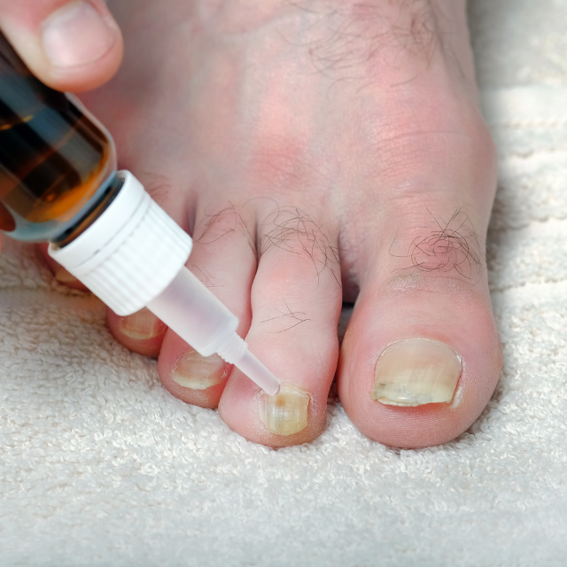 onicomicosis, hongos en las uñas, tratamiento de hongos en las uñas, infección por hongos en las uñas, tratamiento láser para hongos, prevención de hongos en las uñas.