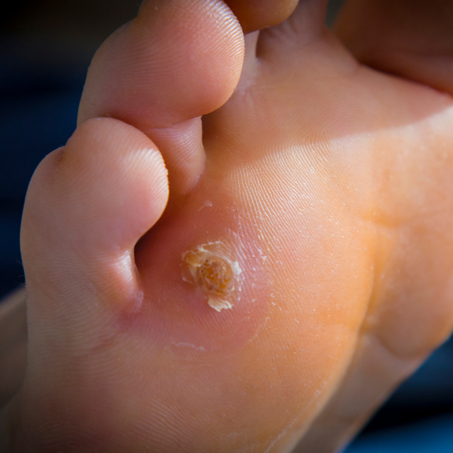 callosidades, tratamiento de callosidades, eliminación de callos, prevención de callosidades, pedicura médica, callos en los pies.