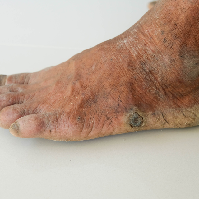 pies diabéticos, cuidado de pies diabéticos, neuropatía diabética, prevención de úlceras diabéticas, calzado para diabéticos, revisión de pies diabéticos.